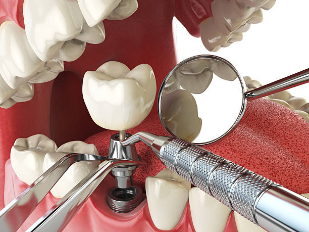 Best Broken or Chipped Tooth Repair in Pond Creek, OK